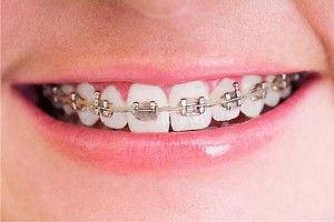 Es normal tener mal aliento por los aparatos dentales?