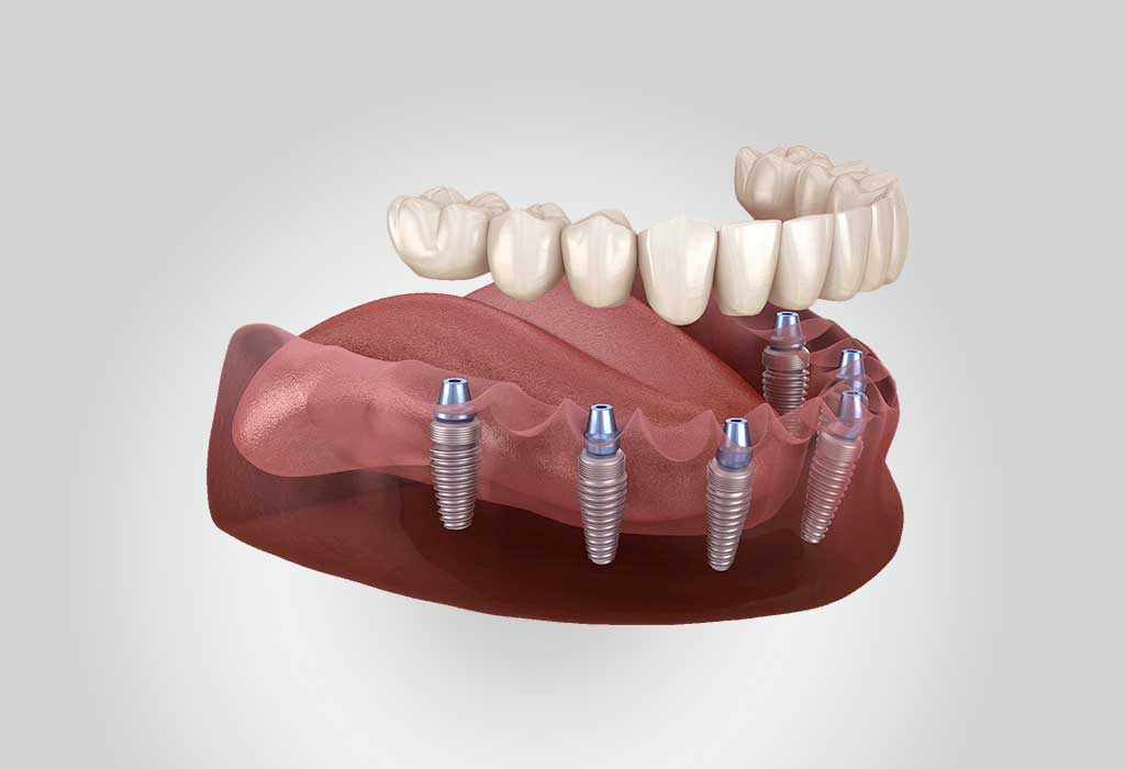 Implantes de carga inmediata en Sant Cugat. Descubre la innovación en Dental Vallès En Dental Vallès, ubicado en Sant Cugat, nos enorgullece ofrecer soluciones avanzadas y efectivas para la rehabilitación dental.